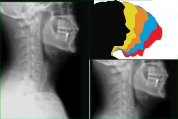 spine health in jeopardy text-neck syndrome soars among young adults