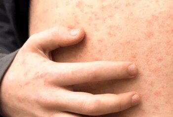 Second child dies of measles in Mongolia's capital