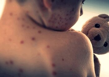 Mongolia's measles cases surpass 13,000