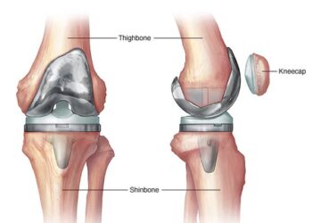 India needs more skilled surgeons for revision knee, hip replacement surgeries, say experts